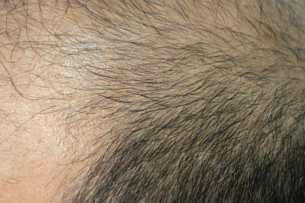 秃顶男人的头皮的特写。秃顶与你的基因和男性性激素有关。图片下载