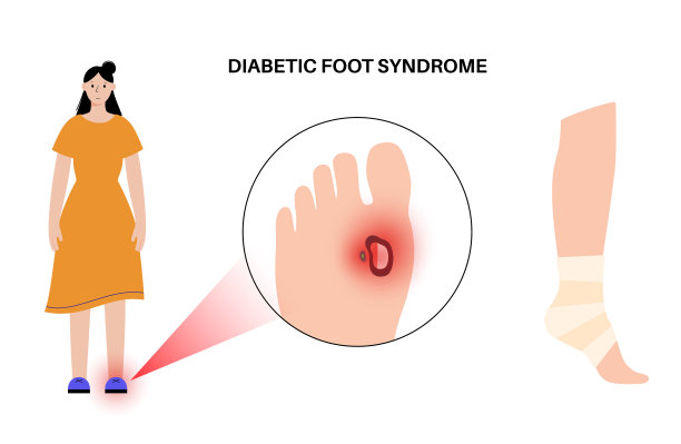糖尿病足溃疡图片下载