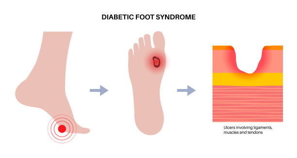 糖尿病足溃疡图片下载