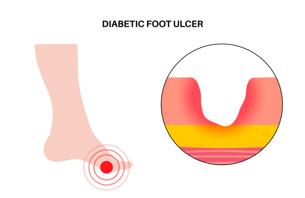 糖尿病足溃疡图片下载
