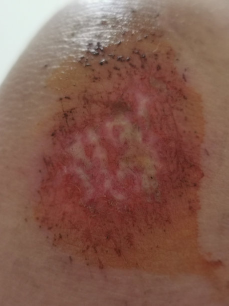 感染性炎症伤口图片下载