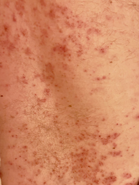 背部有皮疹图片下载