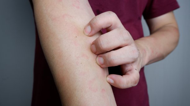 手臂遭受严重荨麻疹或荨麻疹或荨麻疹的特写图像。过敏症状。图片下载