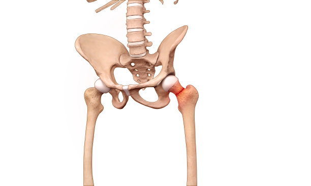 股骨骨折的骨骼图图片下载