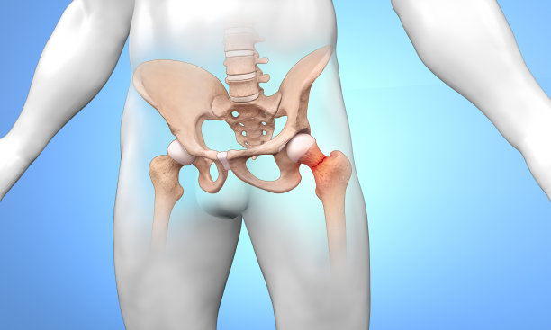 股骨颈骨折图片下载