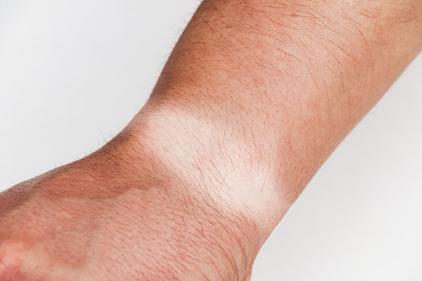 手腕上晒黑留下的表印图片下载