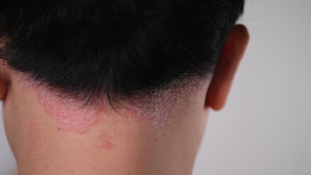 男人脖子上的牛皮癣。皮肤有牛皮癣。图片下载