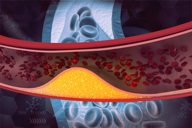 动脉阻塞。动脉斑块图片下载