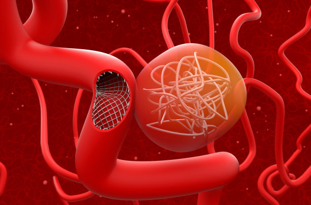 用网状支架和线圈治疗动脉瘤(剖面图)-三维插图特写视图图片下载