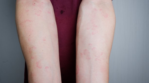 手臂遭受严重荨麻疹或荨麻疹或荨麻疹的特写图像。过敏症状。图片下载
