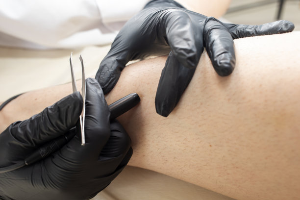 无法辨认的皮肤科医生正在为女子的小腿做脱毛电解手术。多毛症，毛发过多。在美容院的电子脱毛。真实的照片。水平面图片下载