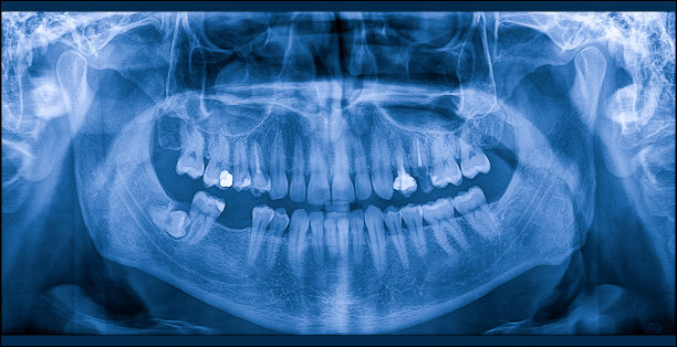 在x光片上长出智慧牙痛图片下载