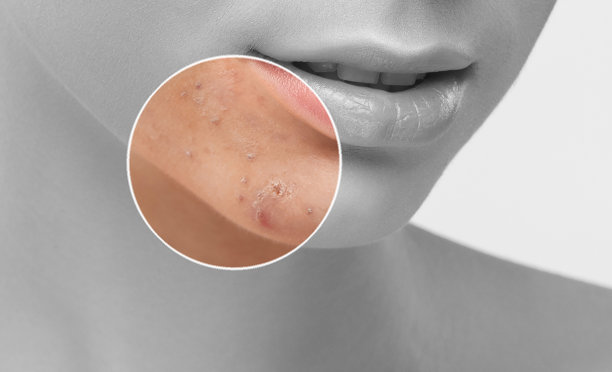 一个皮肤有问题的年轻女孩。照片为痤疮和Demodecosis治疗前后对比。皮肤护理，水疗。美容及专业护肤。图片下载