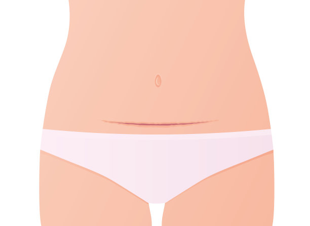 剖腹产后有疤痕的女性腹部图片下载