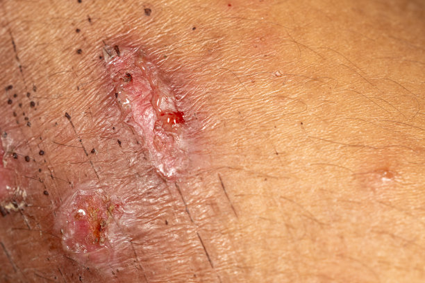 近距离腿部和手部受伤，伤口较新。图片下载