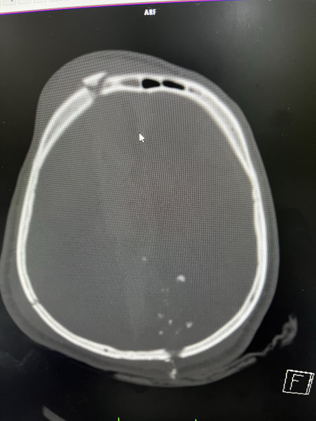 41岁男性患者，在婚礼上枕骨区域中弹后，脑部CT显示蛛网膜下腔出血和骨折。2023年，土耳其科尼亚图片下载