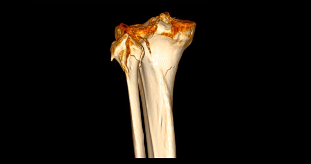 膝关节CT扫描显示胫骨、腓骨骨折3D效果图。图片下载
