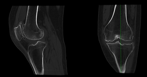 髌骨骨折患者膝关节矢状面及冠状面CT扫描。图片下载