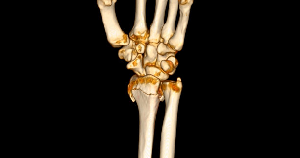腕关节CT扫描三维渲染诊断腕关节疼痛。图片下载