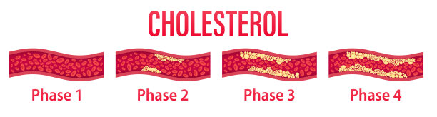 动脉胆固醇、心脏脂肪、健康风险、血流、血管概念。胆固醇阻塞动脉模板。血管元素中的图形斑块。医疗保健的概念。矢量图图片下载