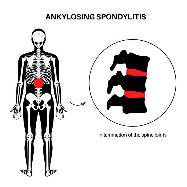 强直性脊柱炎图片下载