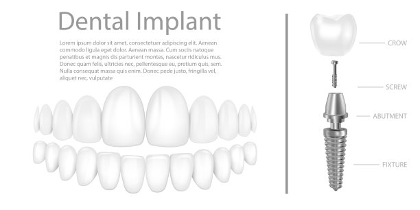 牙种植体结构医学图片教育信息图海报与磨牙替代末端健康工具模型矢量插图。图片下载
