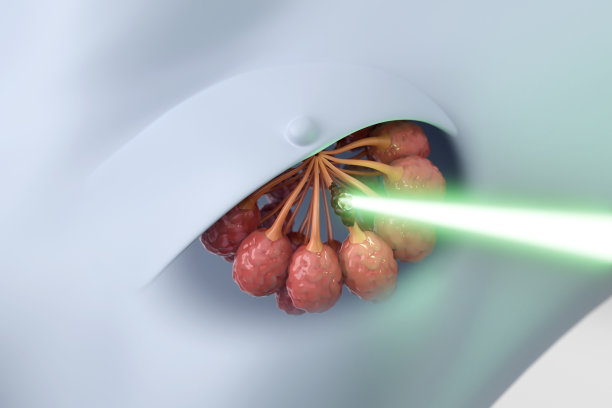 乳腺癌的放射治疗图片下载