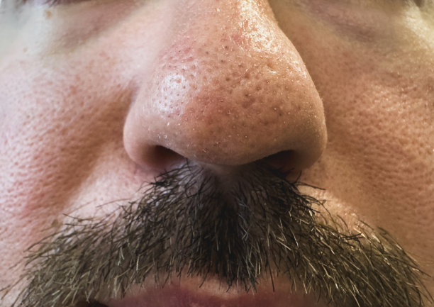 粉刺和毛孔问题。挤黑头疙瘩用。粉刺皮肤问题特写。皮肤护理治疗。图片下载