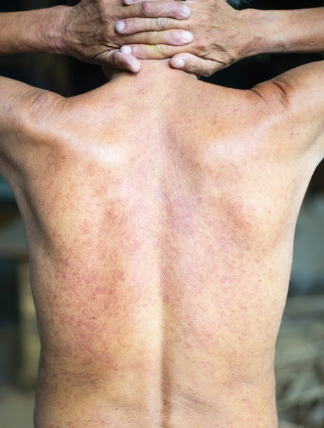 由于老年人过敏，皮肤发红发痒图片下载