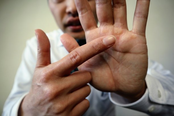 一名日本男子指着手上的水泡图片下载