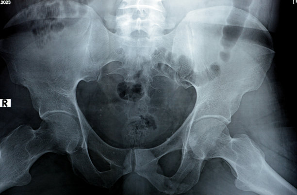 髋关节数字X线照片检查显示髋关节外观正常，多发性盆腔静脉石，双侧髋臼加深，股骨头球形轮廓图片下载