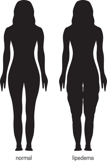 以女性轮廓正常及脂肪水肿图片下载