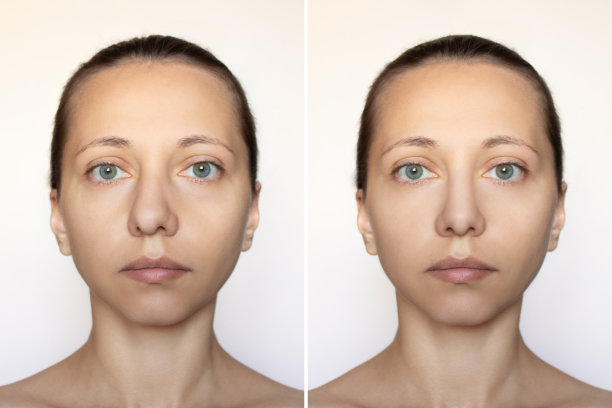 这是一个女人隆鼻前后的脸部照片图片下载