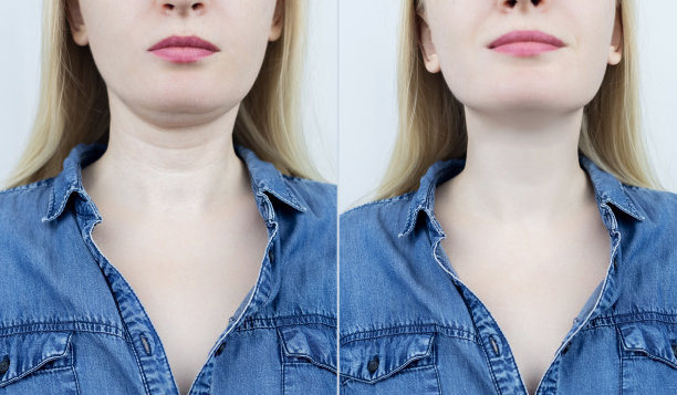 金星戒指。颈部皮肤因失去弹性而皱褶。用整形手术、肉毒杆菌毒素、塑造或收紧颈部皮肤来去除皱纹。美容缺损的矫正图片下载