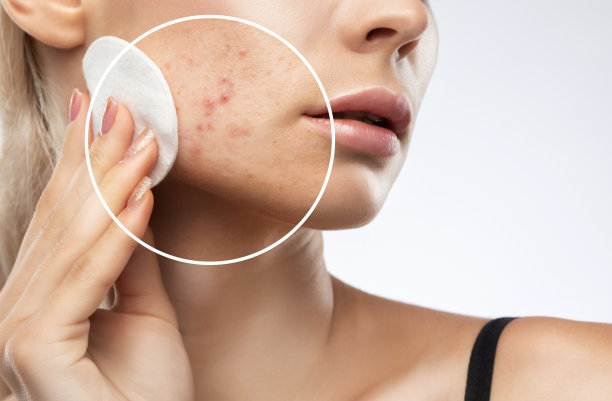 一个皮肤有问题的年轻女孩。痤疮治疗前后的照片。图片下载