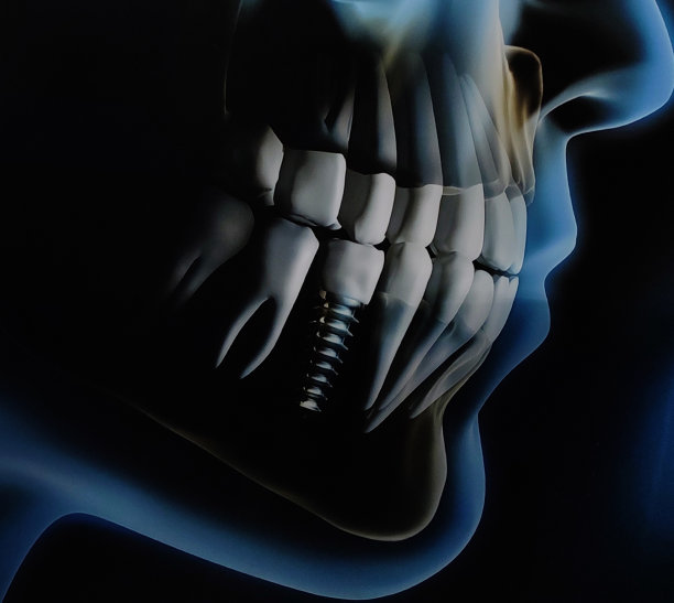 医学可视化-下颌牙齿植入物- 3d渲染库存照片图片下载