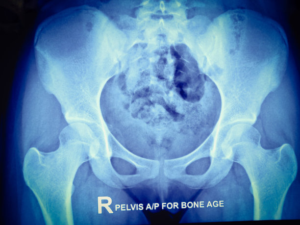 骨盆和髋部x线片。图片下载