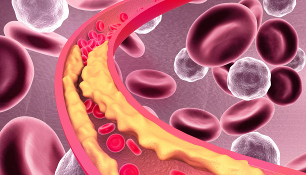 动脉阻塞的科学背景图片下载