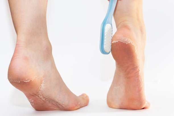 女性脚的特写，高跟鞋上有浮石和剥落的皮革鞋底。白色背景。皮肤护理和足疗图片下载