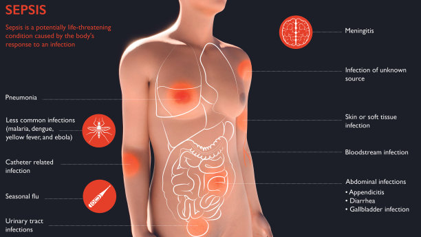 败血症是一种潜在的危及生命的疾病，是由身体对感染的反应引起的图片下载