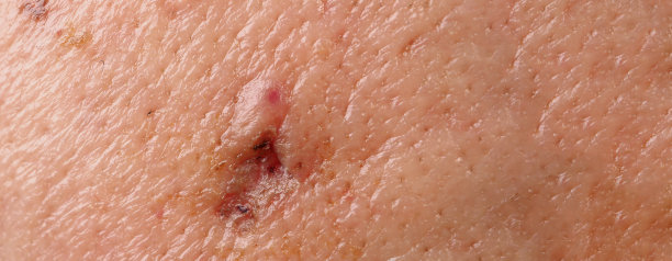 面部脓肿或大的痤疮手术留下的疤痕。医学治疗后皮肤发炎留下的疤痕。接近脸上的疤痕或问题皮肤。图为治疗大脓肿和痤疮后的照片。图片下载