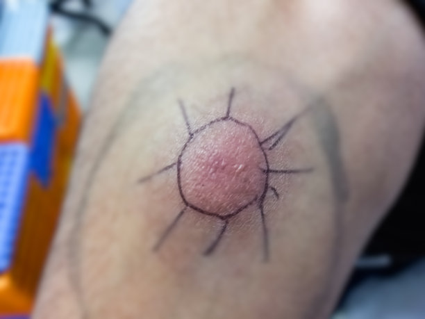 Mantoux结核菌素皮肤试验(TST)，进行Mantoux试验后出现红点反应的患者手臂特写照片。肺结核阳性患者。PPD皮肤试验。图片下载