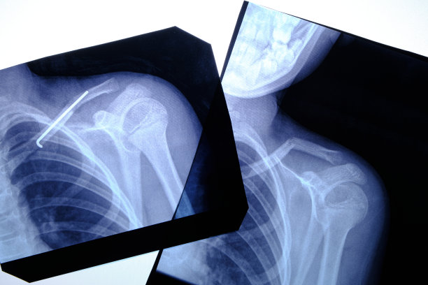 手术后锁骨骨折和插入间隙的两张X线照片。图片下载