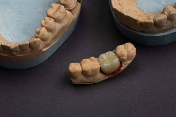 金属陶瓷牙冠用石膏模型保护。图片下载