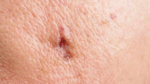 面部脓肿或大的痤疮手术留下的疤痕。医学治疗后皮肤发炎留下的疤痕。接近脸上的疤痕或问题皮肤。图为治疗大脓肿和痤疮后的照片。图片下载