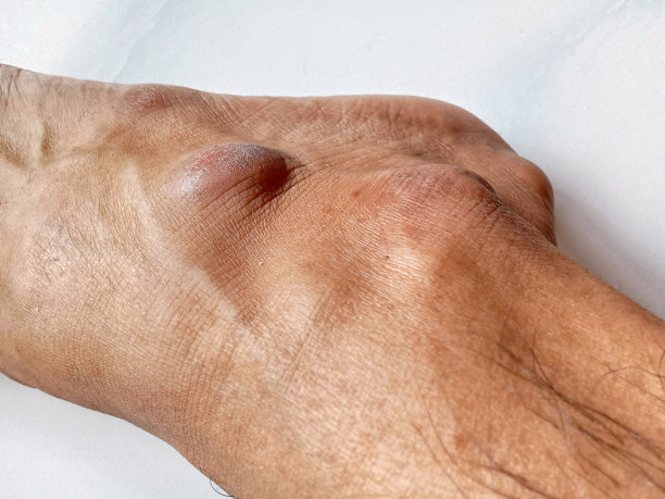 腿上的肿块图片下载