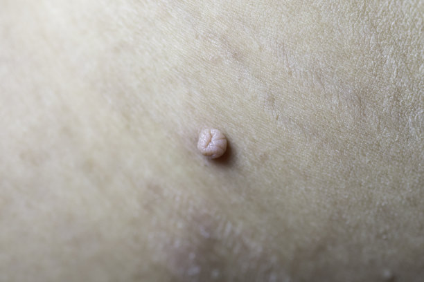 皮赘或肢索或软纤维瘤或痣。宏观照片。乳头状瘤病毒或肿块，皮肤概念上的皮肤病问题。图片下载