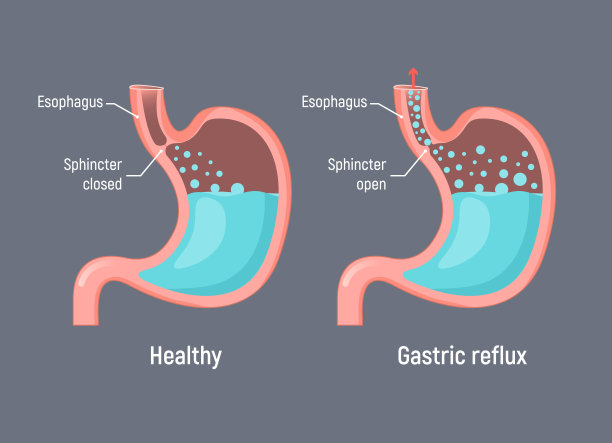 食管胃反流性胃酸消化不良。胃灼热胃反流图片下载