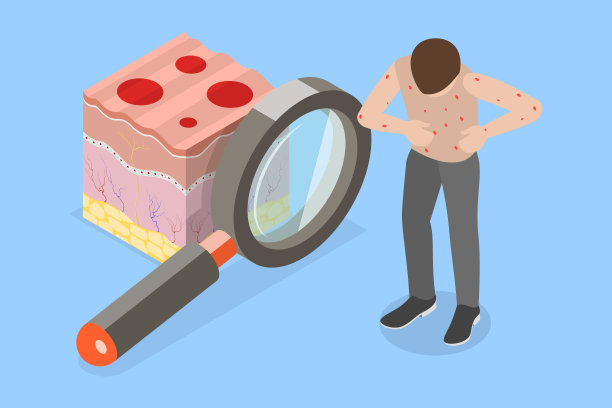 水痘的三维等距平面矢量概念插图图片下载