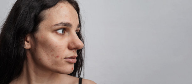 一个满脸粉刺和皮肤问题的年轻女人的特写。横幅上的全景照片。放文字的地方图片下载